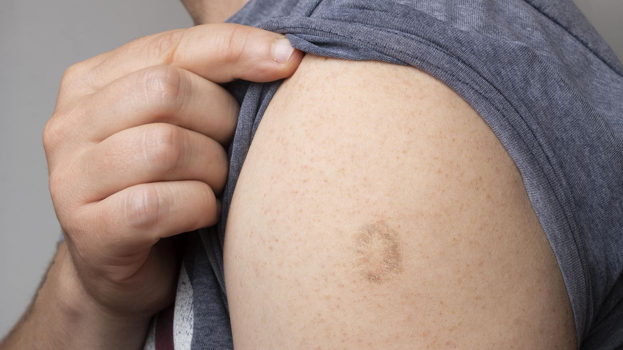 A person with a Monkeypox and Smallpox vaccine scar.