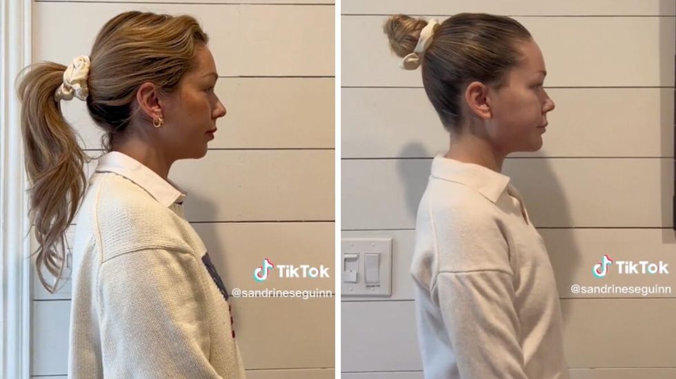 Avant et apr\u00e8s l'op\u00e9ration de Sandrine.