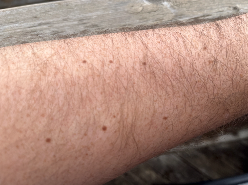 Birthmarks on a pale, hairy arm.
