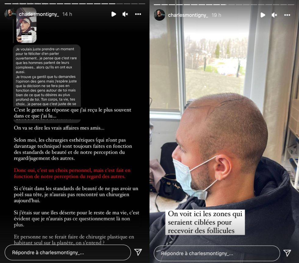 Charles Montigny parle de sa perte de cheveux.
