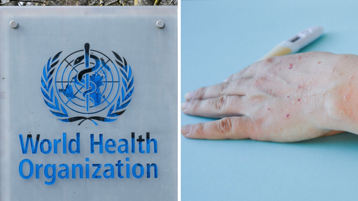 Enseigne de l'Organisation mondiale de la santé. Droite : Main avec lésions de la variole du singe.
