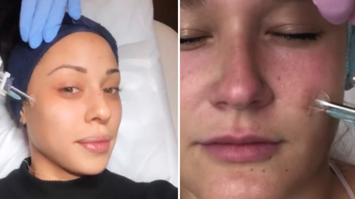 Mon honnête expérience: j'ai essayé le traitement d'injections « PRP » qui fait triper les influenceurs