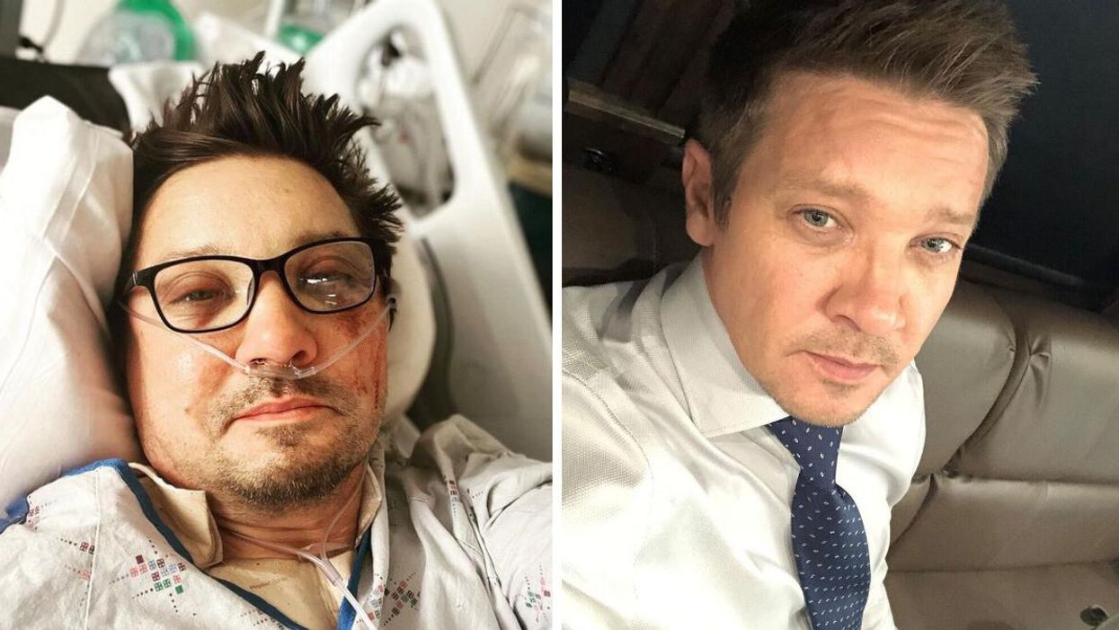 Jeremy Renner after his snowplow accident. Right: Jeremy Renner.