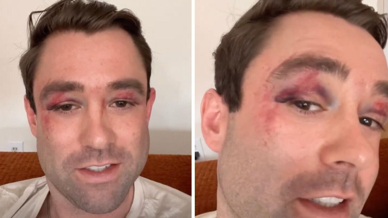 Meteorologist Adam Klotz in his Instagram story. Right: Weatherman Adam Klotz showing his bruises.