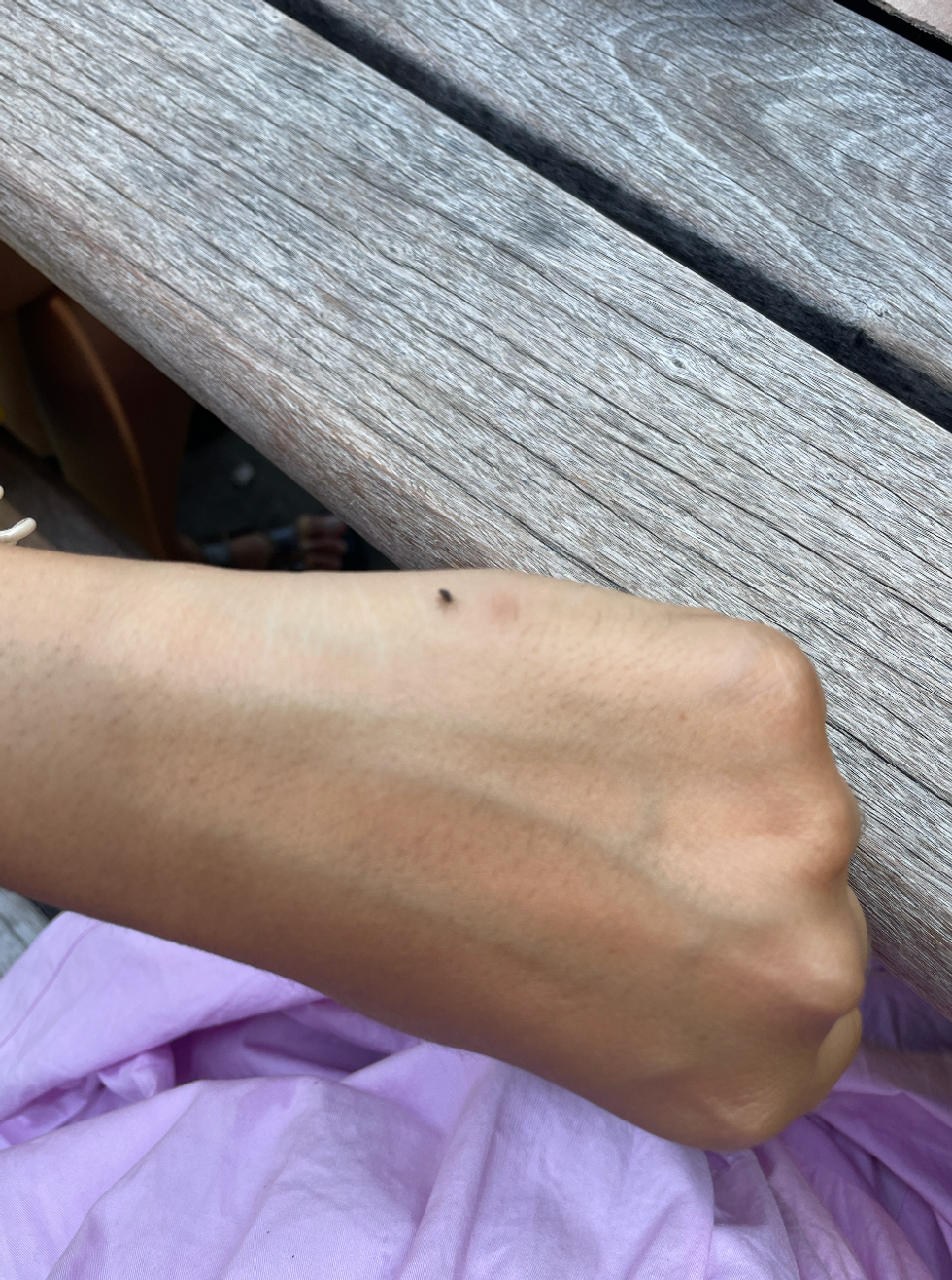 Mira bit by a bug and a bug on her hand.