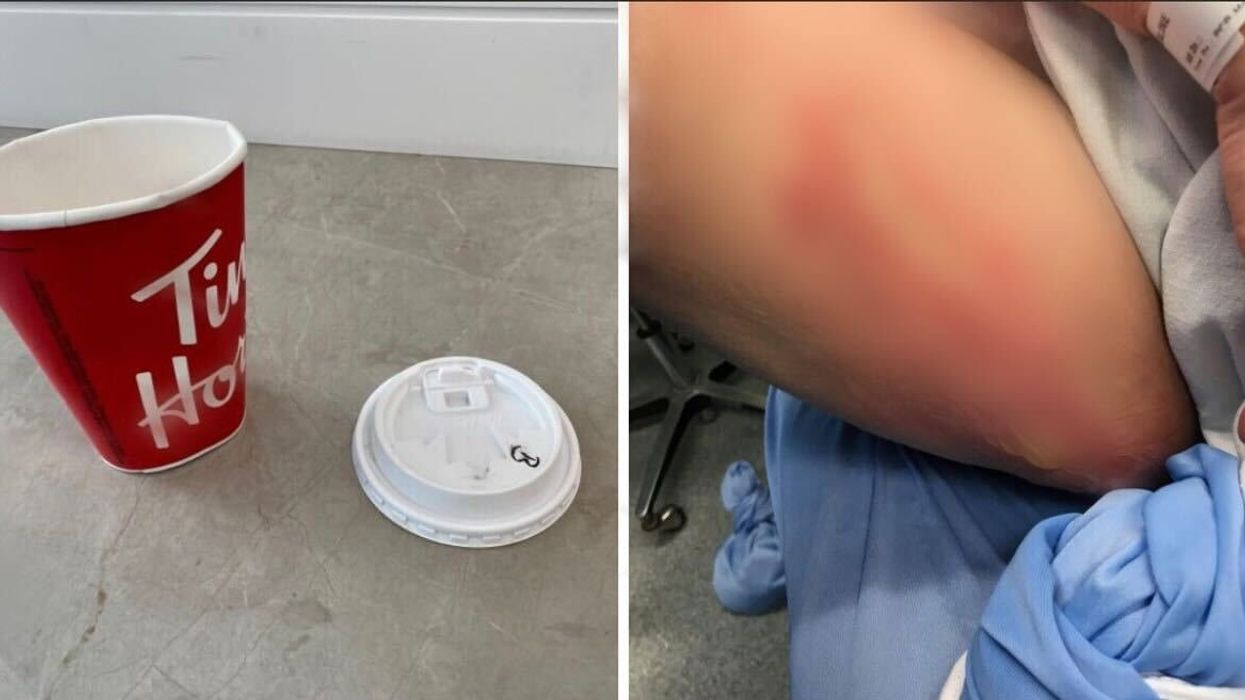 The Tim Hortons cup that allegedly folded in on itself. Right: Burns suffered by 73-year-old Jackie Lansing.