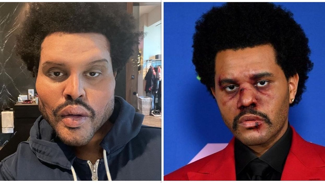 The Weeknd Instagram Face Surgery Prosthetics