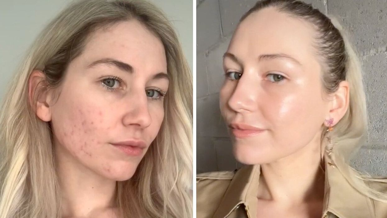 This Canadian TikToker Built A Following By Sharing Her Acne Journey & Here's How She Did It