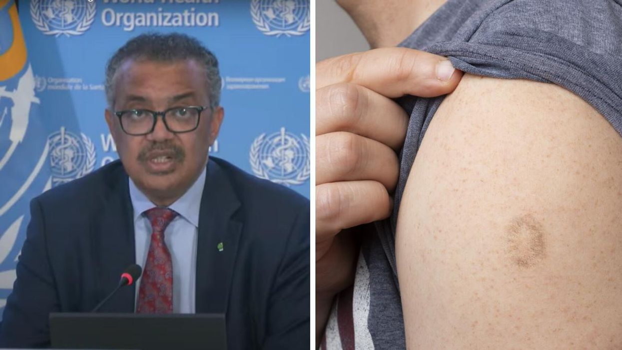 WHO Director-General Tedros Adhanom Ghebreyesus during a media briefing. Right: A person with a smallpox vaccine.